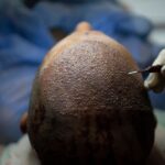 Como a Turquia hackeou a indústria de transplante capilar